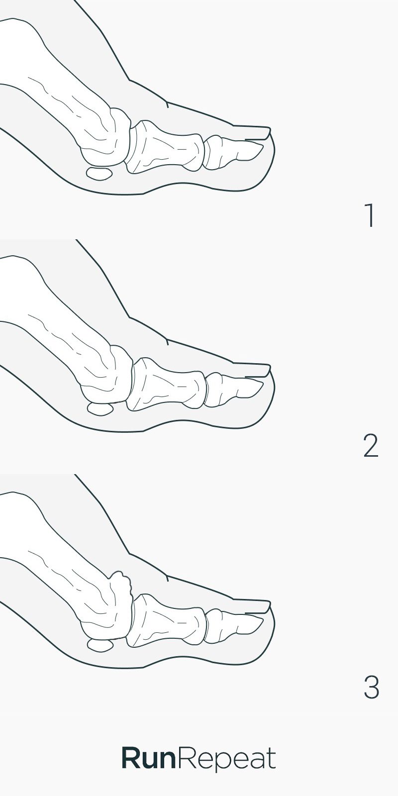 hallux-rigidus-progression.jpg