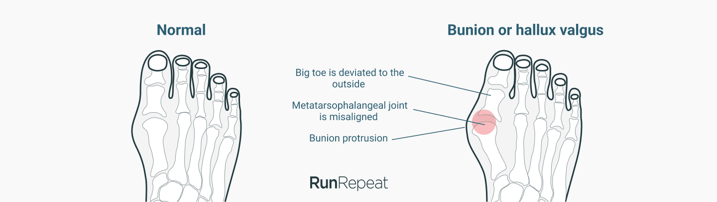 bunions and barefoot shoes