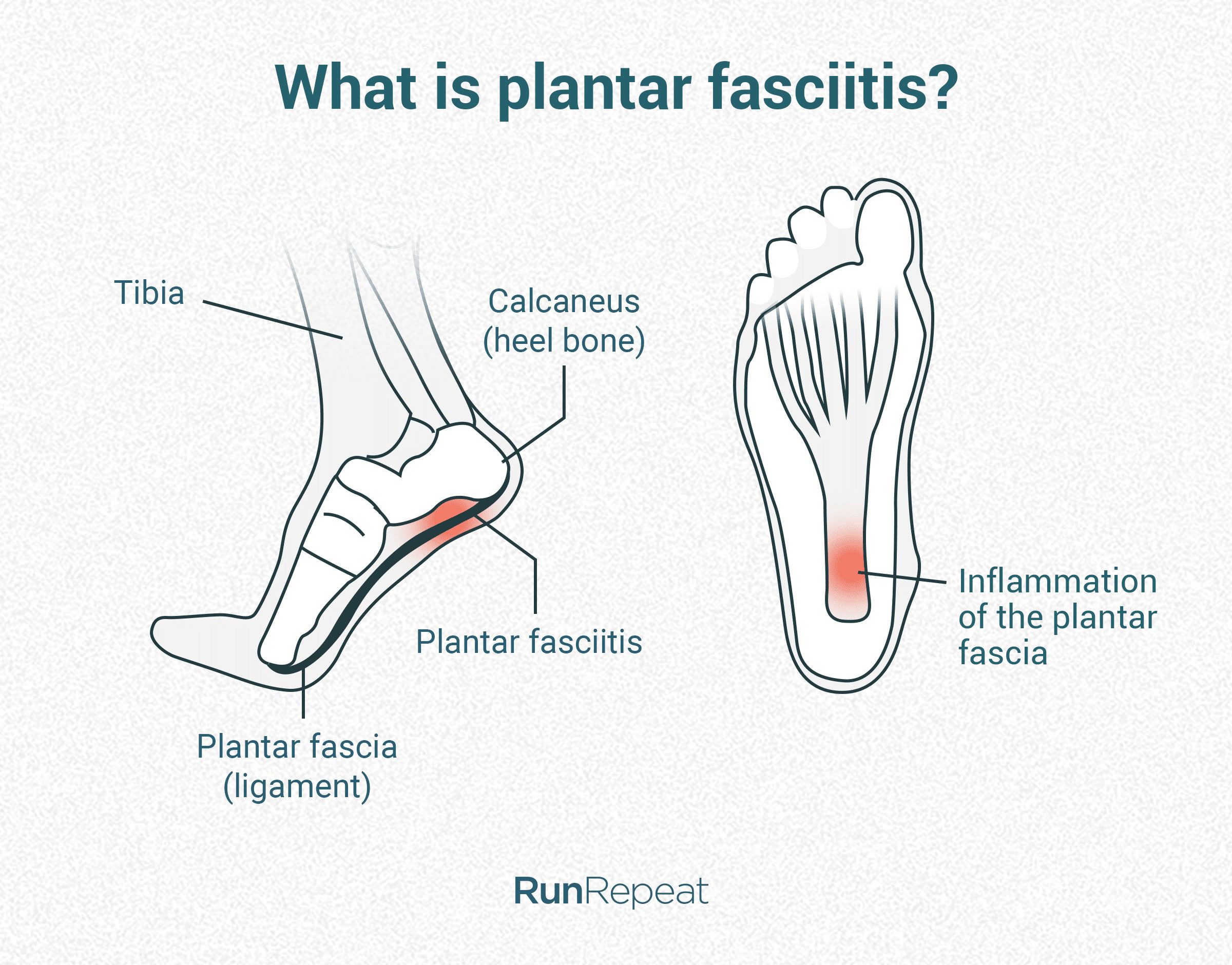 plantar fasciitis and barefoot shoes