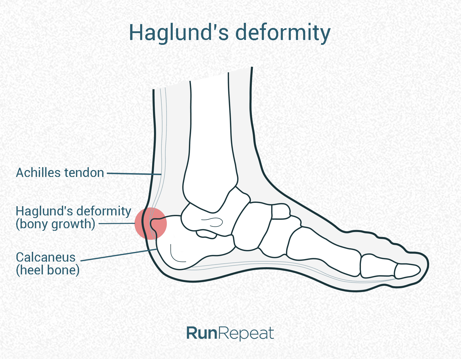 haglunds-deformity-illustration.png