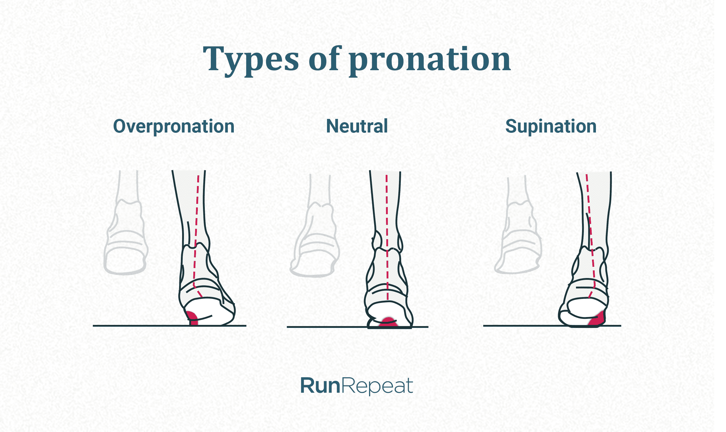 types-of-pronation.png