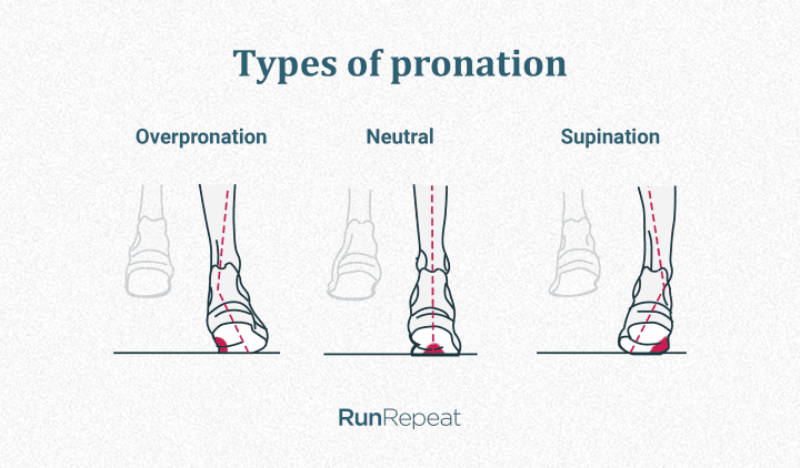Types of pronation.png
