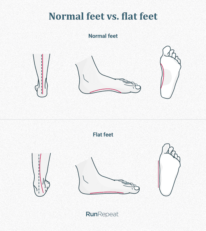 difference-between-normal-and-flat-feet.png