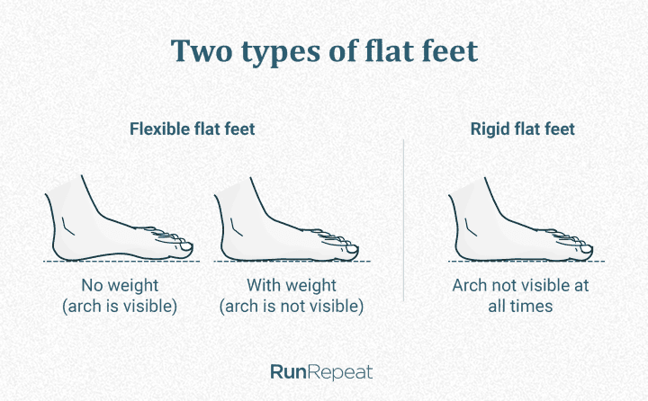 two-types-of-flat-feet.png