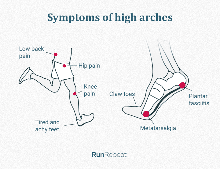 symptoms-of-high-arches.png