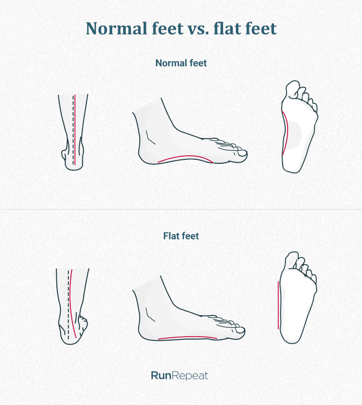 normal-feet-vs-flat-feet.png