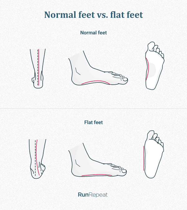 flat foot vs normal