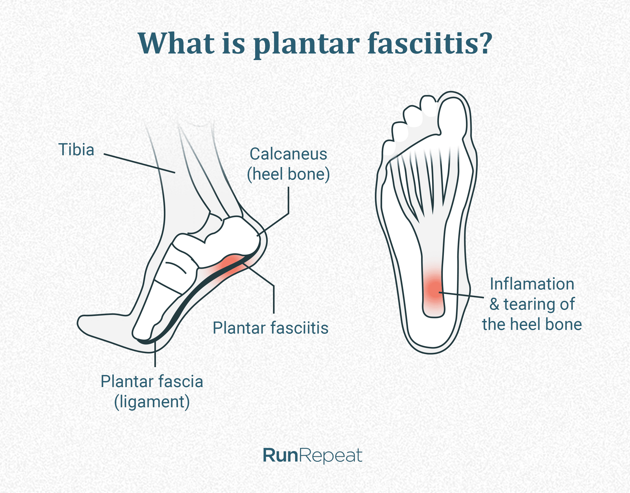 qué es la fascitis plantar