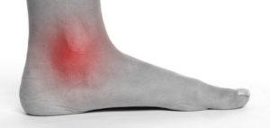 running ankle injury