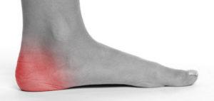 running heel injury