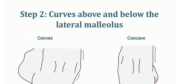 Lateral malleolus curvature