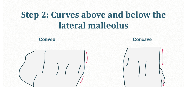 Curvatura del maléolo lateral