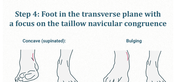 Foot in the transverse plane (navicular congruence)
