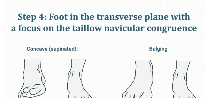 Pie en el plano transversal (congruencia navicular)