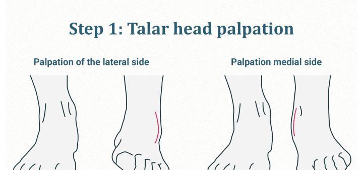 Talar HEAD palpation