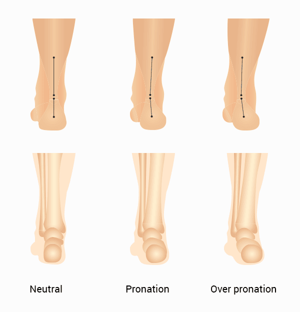 Types Of Foot Pronation